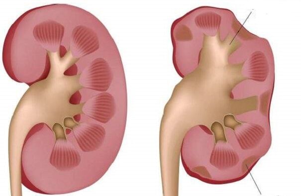 a healthy and diseased kidney when drinking alcohol