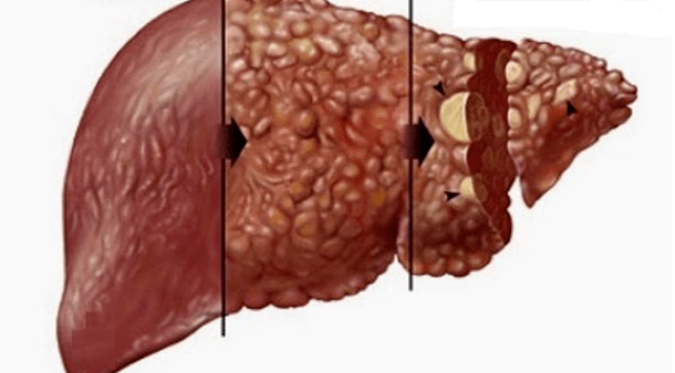 adverse effects of alcohol on the human liver