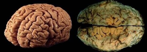 the brain of a healthy and drunk person